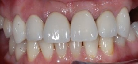 After tooth crowns