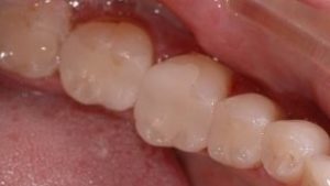 Amalgam Fillings Removal - After