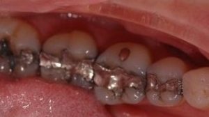 Amalgam Fillings Removal - Before