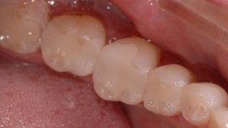 After tooth crowns