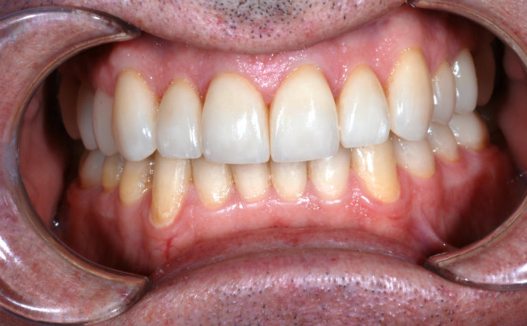 Smile (retracted) after cosmetic dentistry