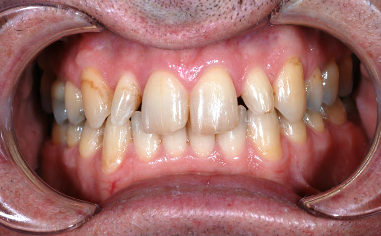 Smile (retracted) before cosmetic dentistry