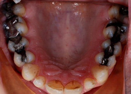 Before amalgam fillings removal