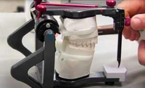 TMJ dysfunction - dental articulator